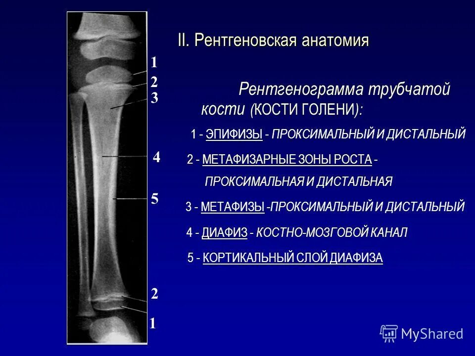 Перелом дистального метаэпифиза малоберцовой кости. Строение большеберцовой кости рентген. Отделы длинной трубчатой кости рентген. Анатомия большеберцовой кости рентген.