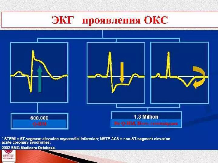 Экг подъем