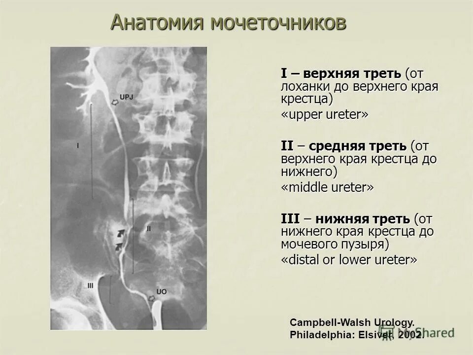экскреторная урография камень мочеточника. обзорная урограмма почек рентген. нижняя треть правого мочеточника. камень средней трети мочеточника. конкремент в верхней трети мочеточника.