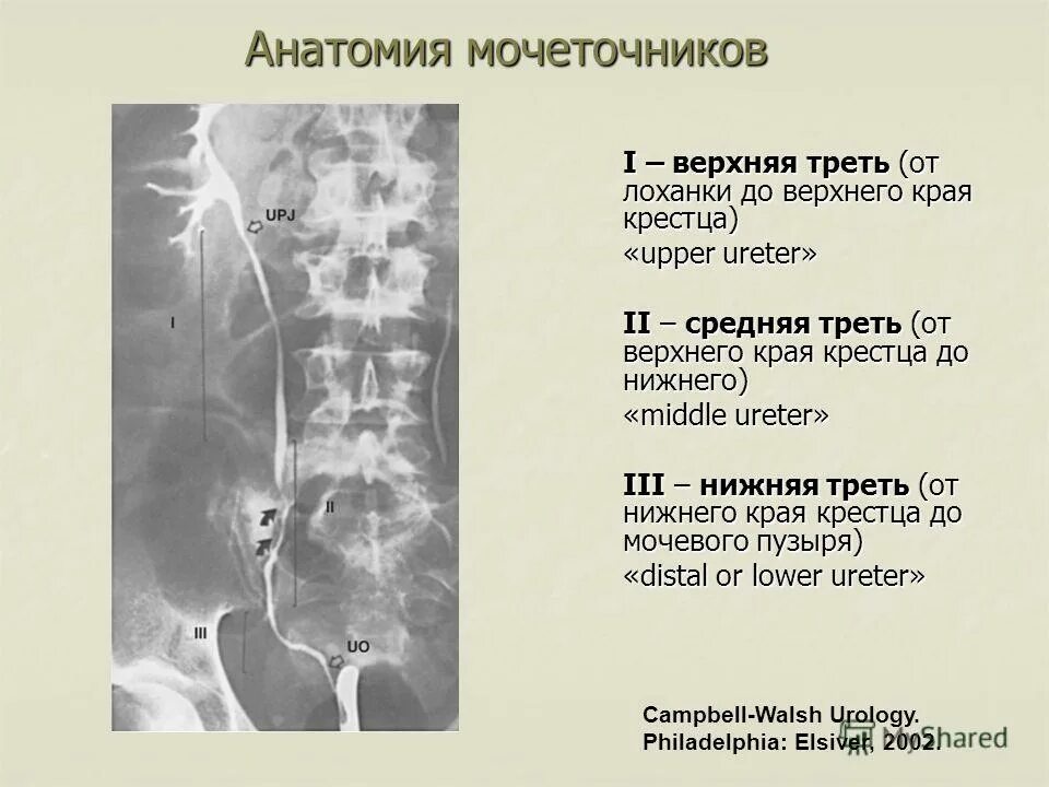 Конкремент в нижней трети мочеточника рентген. Камень нижней трети правого мочеточника. Нижняя треть мочеточника. Камень в нижней трети мочеточника. Н 3 кт