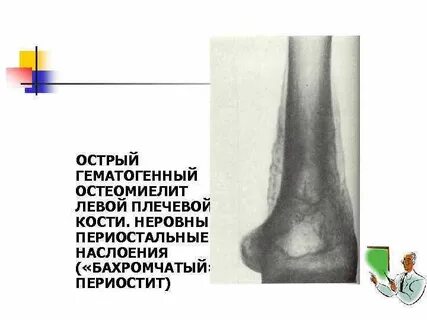 Острый остеомиелит формы