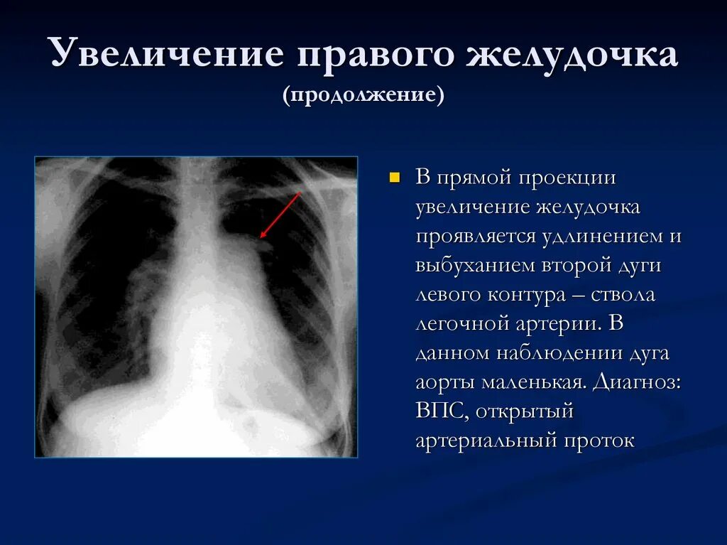 Выбухание дуги легочной артерии на рентгене. Дуга легочной артерии на рентгене. Выбухание легочной артерии. Выбухание ствола легочной артерии. Левое предсердие увеличено