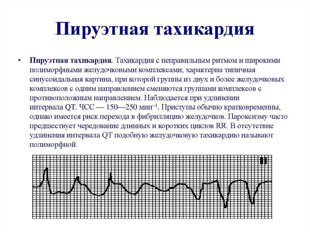 Под тахикардия. Отрицательный зубец р после qrs комплекса. Синусовая тахикардия сердца экг. Синусовая тахикардия у ребенка 1 год. Синусовая тахикардия на экг.