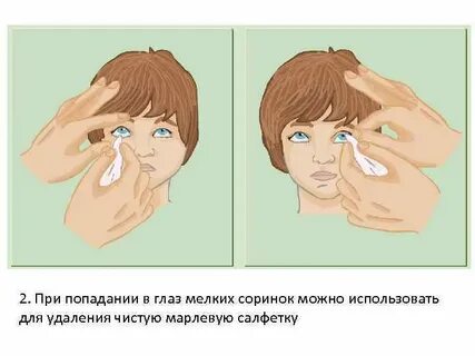 Как вытащить мошку из глаза