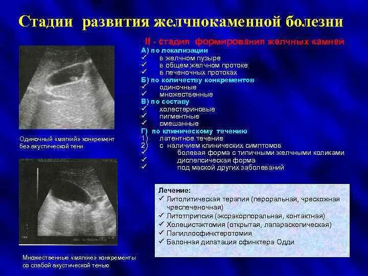 Сонограмма камней в желчном пузыре. Конкременты в желчном пузыре при ультразвуковом исследовании. УЗИ желчного пузыря при желчекаменной болезни.