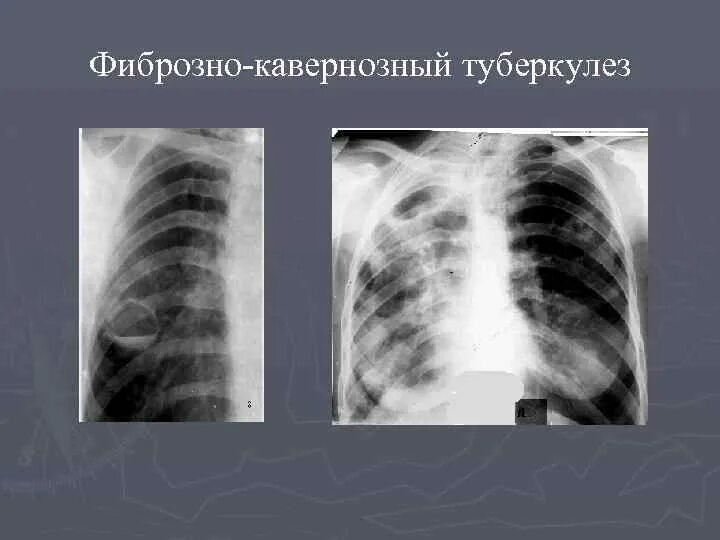 Фиброзно-кавернозный туберкулез кт. Фиброзно кавернозный туберкулез рентгенограмма. Фиброзно-кавернозный туберкулез легких рентген. Туберкулезная каверна рентген.