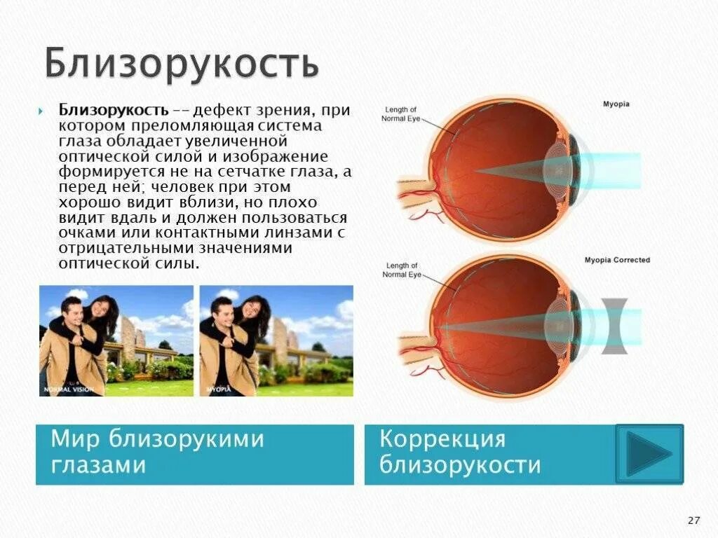 Близорукость (истинная и ложная формы патологии). Миопия 1 степени что это у ребенка. Снижение зрения миопия. Зрение при близорукости.