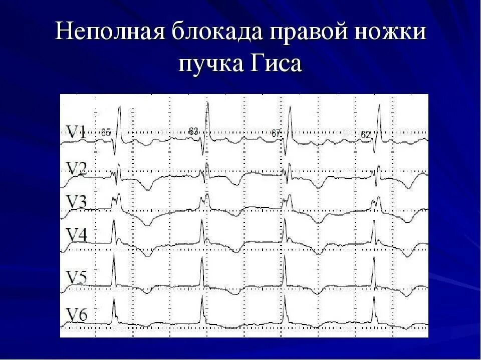 Сердце неполная блокада правой ножки гиса. ЭКГ при неполной блокаде правой ножки. Блокада правой ножки пучка Гиса на ЭКГ что это на ЭКГ. Неполная блокада ПНПГ на ЭКГ. ЭКГ: синусовый ритм. Блокада правой ножки пучка Гиса..