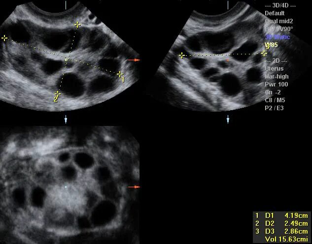 Синдром поликистозных яичников УЗИ. Критерии мультифолликулярных яичников УЗИ. Мультикистозные яичники на УЗИ. Мфя в гинекологии что