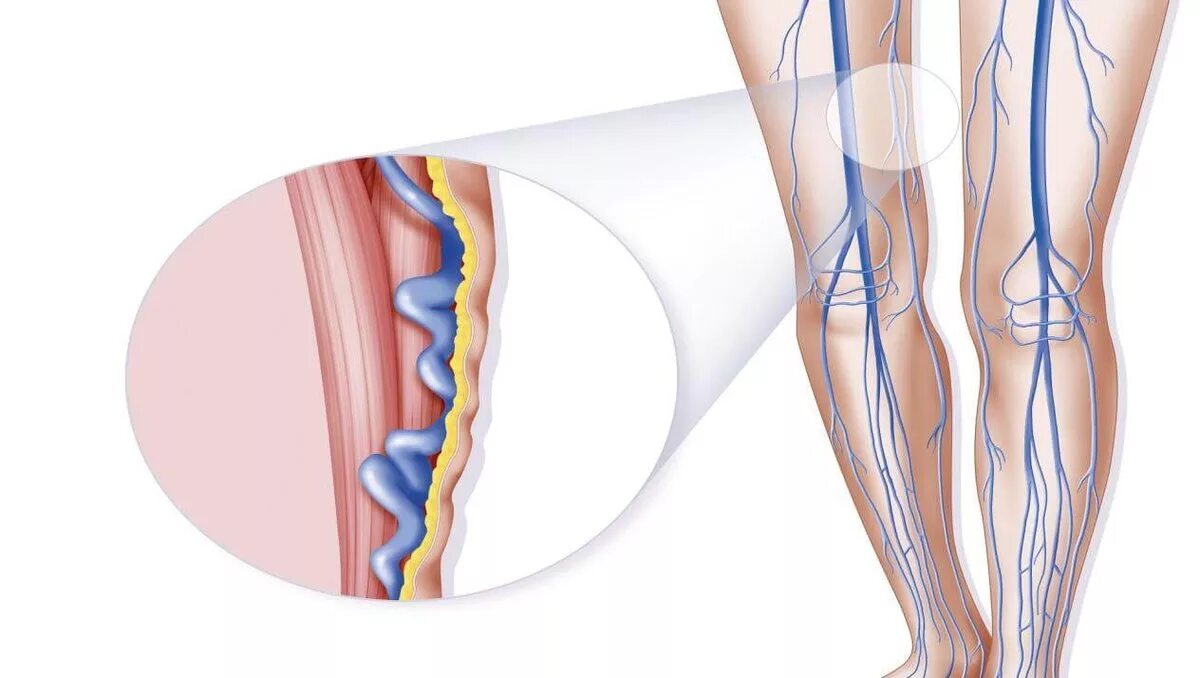 варикозное расширение вен нижних конечностей заключение. варикозное расширение вен голени. облитерирующий тромбофлебит. варикозное расширение вен нижних конечностей стадии классификация. варикозное расширение нижних конечностей.