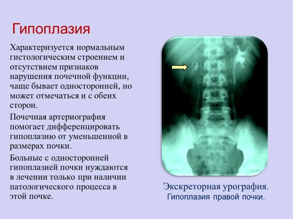 Гипоплазия почки рентген. С гипоплазия левой почки рентген. Односторонняя гипоплазия почки. Врожденная гипоплазия почки. Правая почка меньше левой