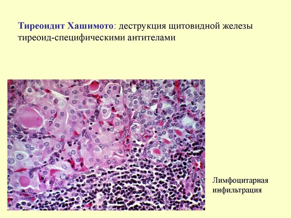 Аутоиммунный тиреоидит зоб Хашимото микропрепарат. Хронический иммунный тиреоидит Хашимото микропрепарат. Аутоиммунный тиреоидит микропрепарат патанатомия. Патология щитовидной железы гистология. Аутоиммунный зоб