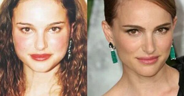 Натали портман до и после пластики Natalie Portman Plastic Surgery Has she had a Nose Job Plastic surgery, Nose