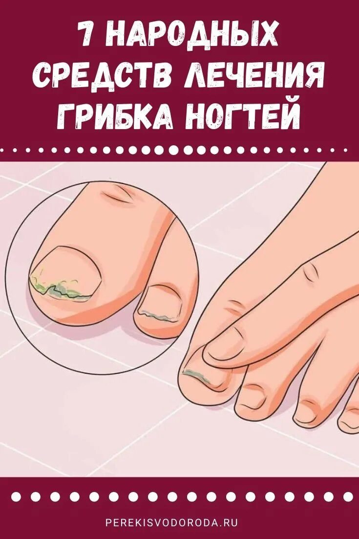 Средство для грибка ногтей на ногах. Можно избавиться от грибка ногтей