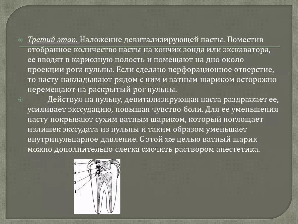 Пульпит метод девитальной экстирпации. Методика наложения девитализирующей пасты. наложение девитализирующей пасты при пульпите. этапы наложения мышьяковистой пасты. наложение мышьяковистой пасты на зуб.