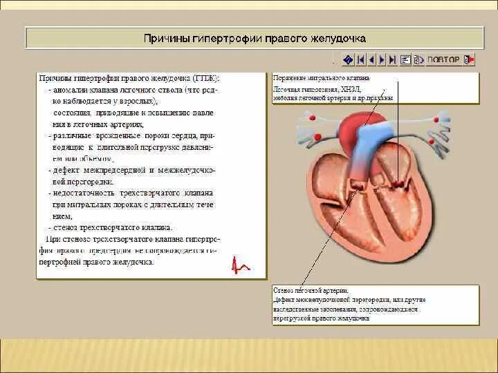 Гипертрофия правого желудочка патогенез. Гипертрофия правого желудочка у спортсменов. Гипертрофия правого желудочка наблюдается. Масса миокарда левого желудочка при гипертрофии. Миокард правого желудочка сердца