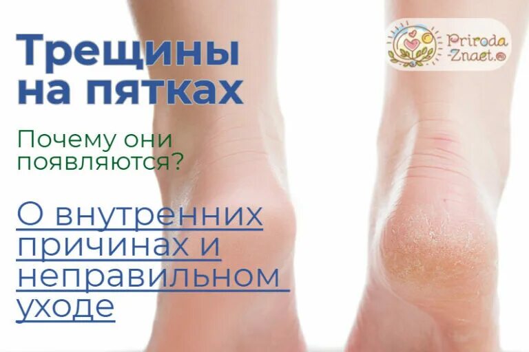 Почему пятки пахнут сыром