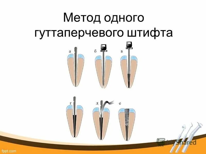 Пломбирование 1 корневого канала(методом латеральной конденсации). Гуттаперчевые штифты для пломбирования корневых каналов зубов. Пломбирование методикой одного штифта. Пломбирование 1 корневого канала гуттаперчей. Метод пломбирования канала центральным штифтом.