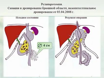 Санация операция