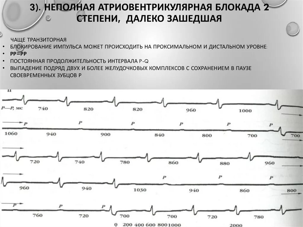 Как часто делают блокаду. Атриовентрикулярная блокада 2 степени на ЭКГ. Неполная АВ блокада 2 степени Мобитц 1. ЭКГ при АВ блокаде 2 степени. Av блокада 2 степени далекозашедшая на ЭКГ.