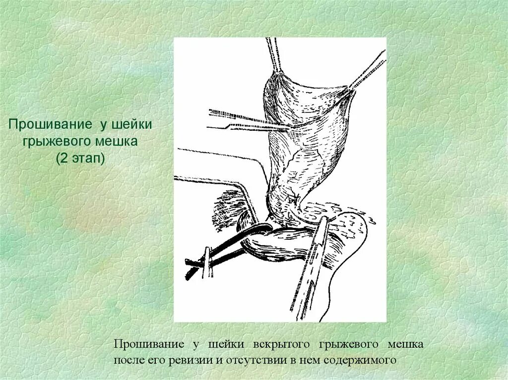 Стенка грыжевого мешка. Прошивание шейки грыжевого мешка. схема рассечения грыжевого мешка. стенки грыжевого мешка. перевязка шейки грыжевого мешка.