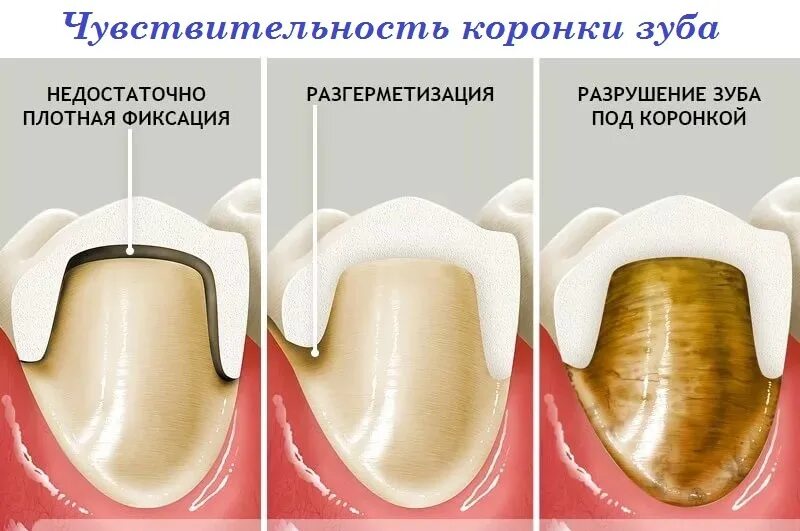 Какие зубы можно лечить