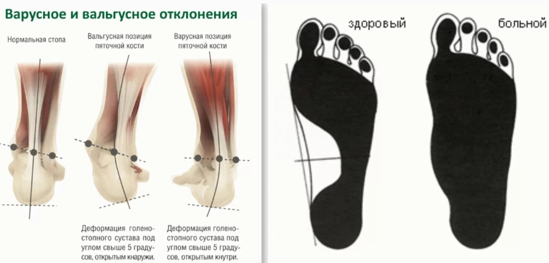 Облегченная стопа. Плоско вальгусная варусная стопа. Вальгусная стопа и варусная стопа. Вальгус стопы это плоскостопие. Плоско варусная деформация стопы.