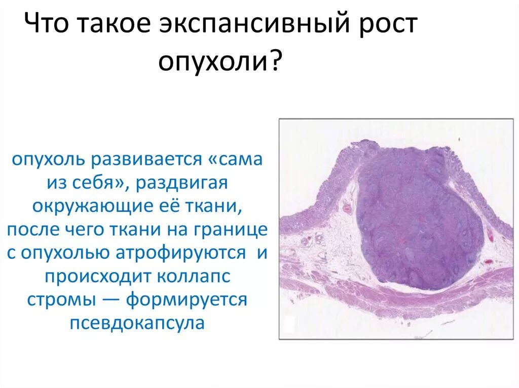 Типы роста опухолей. Инфильтрирующий рост опухоли. Экспансивный рост опухоли. Опухоли введение