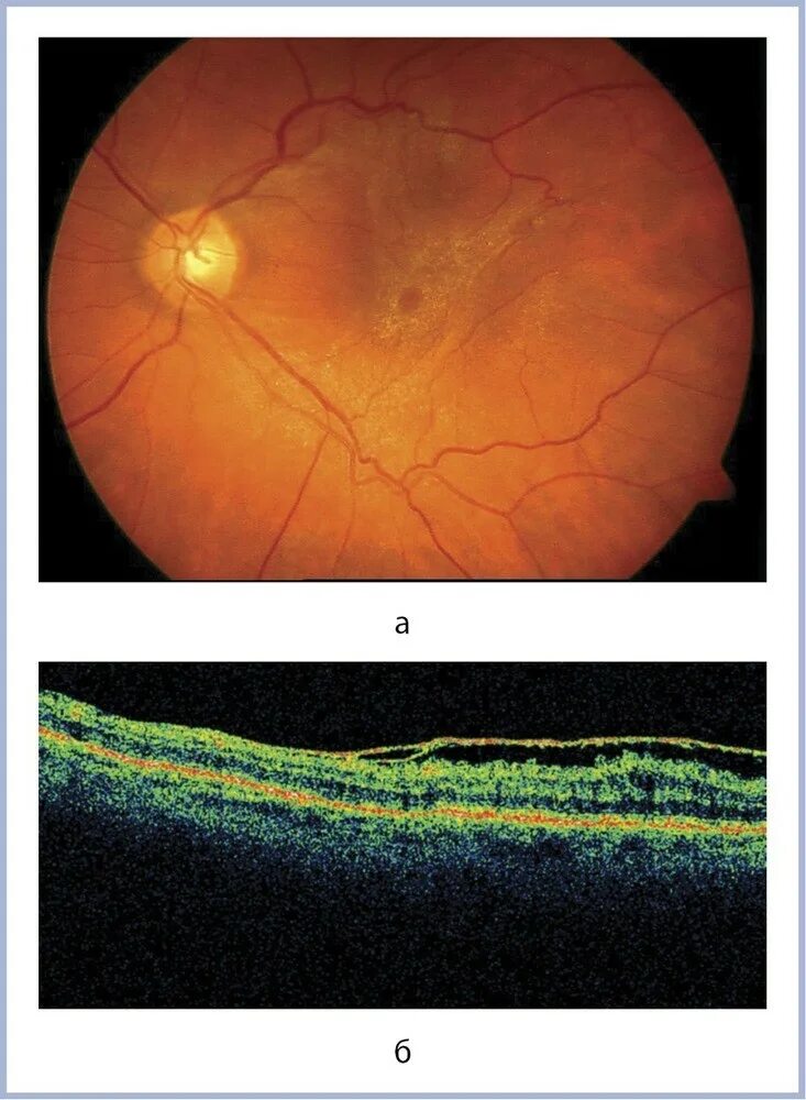 Макулярный отек лечение. Эпиретинальная мембрана сетчатки. Эпиретинальная мембрана на окт. Эпиретинальная мембрана (целлофановая макула). Эпимакулярный фиброз глаза что это.