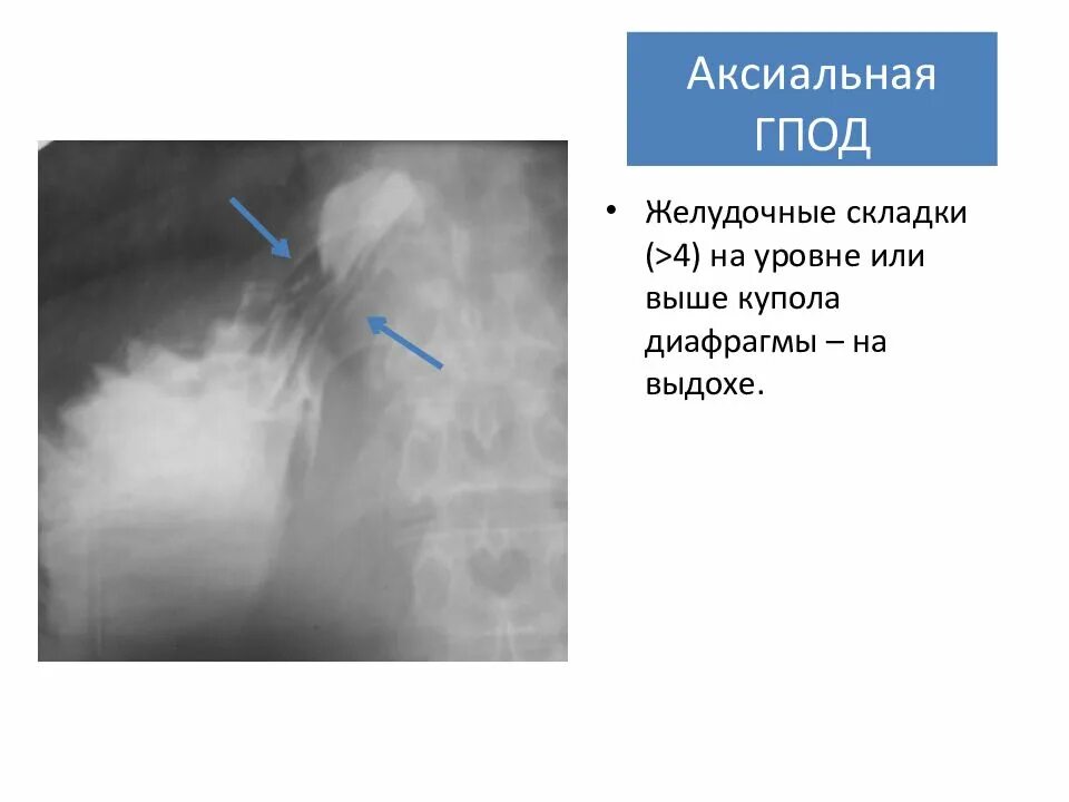 Кардиальная грыжа под. Скользящая аксиальная грыжа пищеводного отверстия диафрагмы рентген. Аксиальная скользящая ГПОД 1. Грыжа пищеводного отверстия диафрагмы 1-2 степени. Аксиальная грыжа пищеводного отверстия диафрагмы 1 степени.