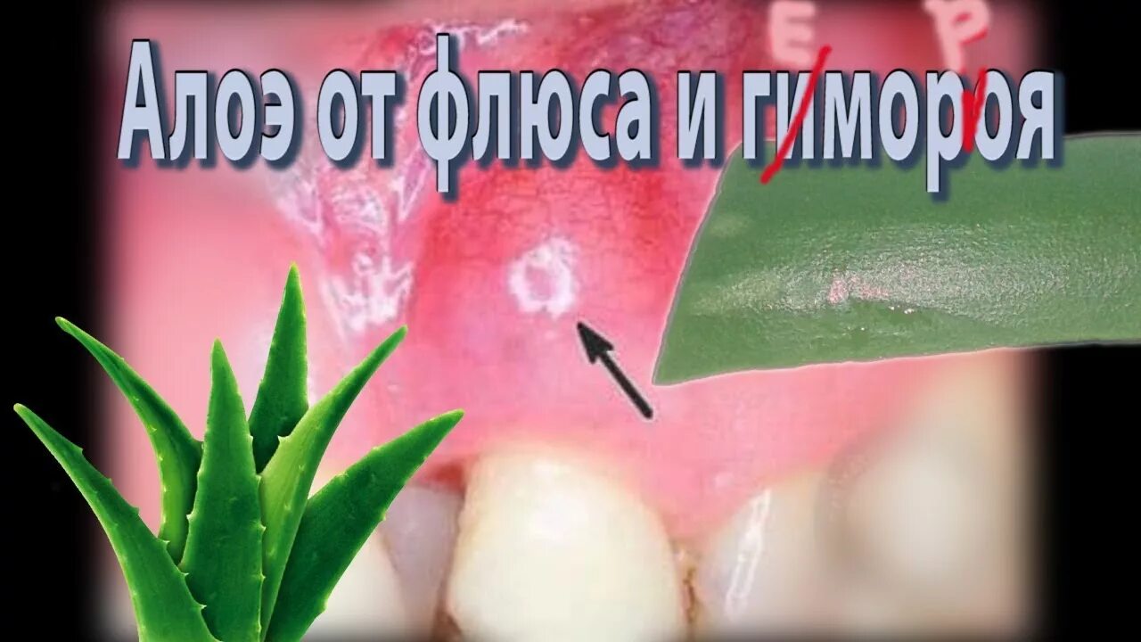 Убрать флюс быстро и эффективно. Столетник и геморрой. алоэ от флюса.