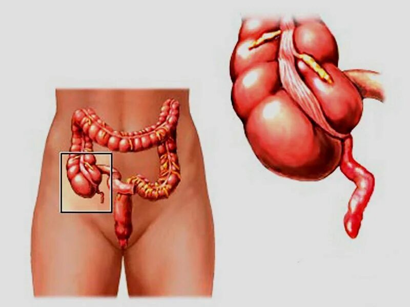 Анатомия человека аппендикс. Аппендицит воспаление кишечника. Аппендикс воспаление операция. Анатомия человека органы аппендикс. Болит правый бок яичники