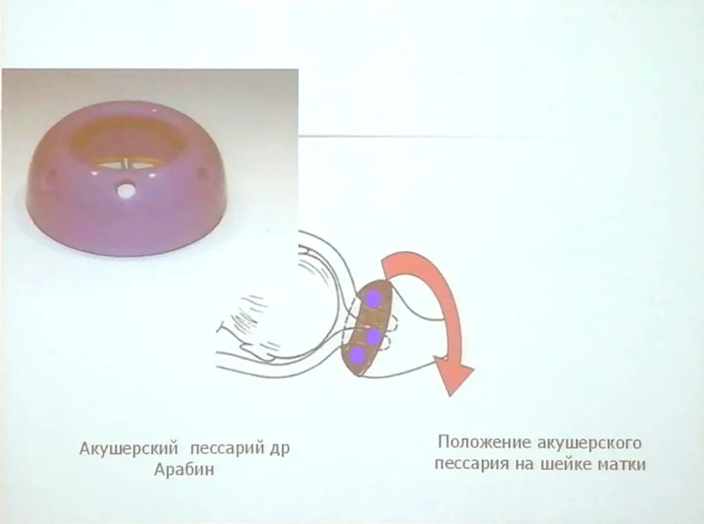 Пессарий для беременных для чего. Акушерский пессарий доктор арабин. маточный пессарий арабин. акушерский разгружающий пессарий доктор арабин. пессарий для беременных доктор арабин.