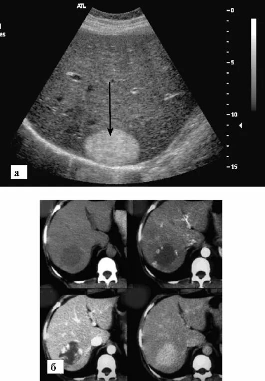 Удаление опухолей печени. Кавернозная гемангиома на УЗИ. Кавернозная гемангиома печени кт. Гемангиомы печени при УЗИ характеризуются.
