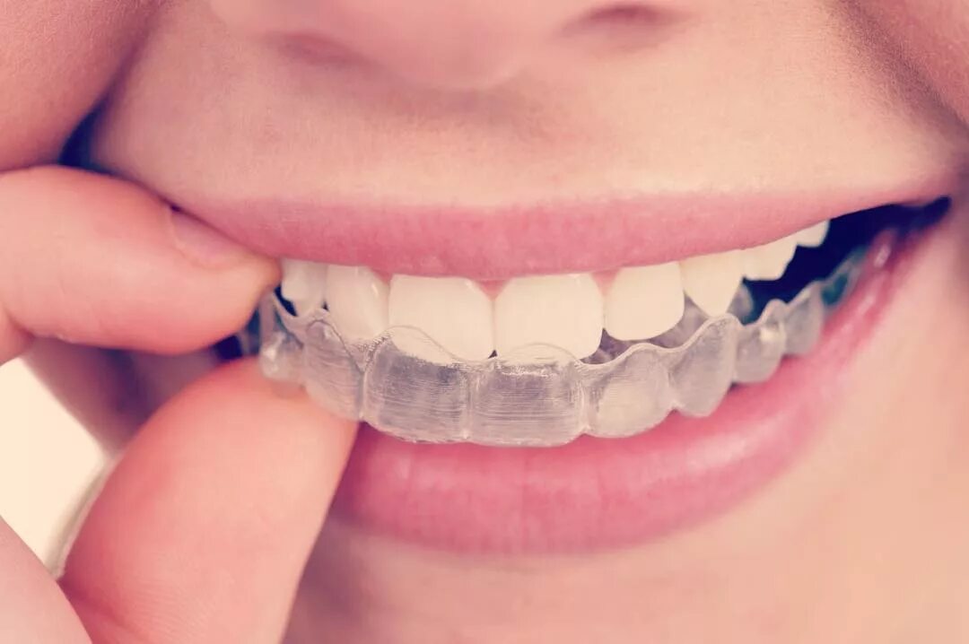 Каппы инвизилайн invisalign. Как выровнять зубы взрослому. Каппы инвизилайн invisalign. Как выровнять зубы взрослому. Как выровнять зубы взрослому.