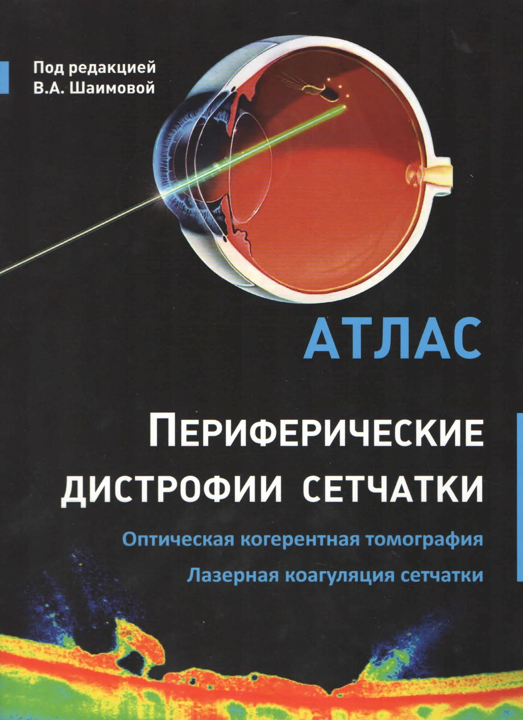 Витреолизис цена. Оптическая когерентная томография сетчатки книга. Периферические дистрофии сетчатки атлас. Периферическая дистрофия сетчатки.