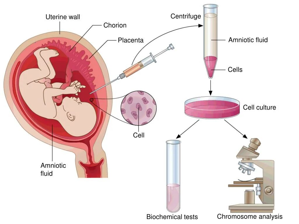 Амниоцентез кордоцентез хорионбиопсия. Исследование околоплодных вод амниоцентез. Биопсия хориона амниоцентез кордоцентез. Пренатальная диагностика амниоцентез. Анализ околоплодных вод