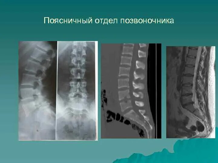 Рентген крестцового отдела позвоночника подготовка. Болезнь Бехтерева рентген грудного отдела. Рентген грудного отдела позвоночника Бехтерева. Болезнь Бехтерева позвоночник кт. Болезнь Бехтерева грудной отдел позвоночника рентген.