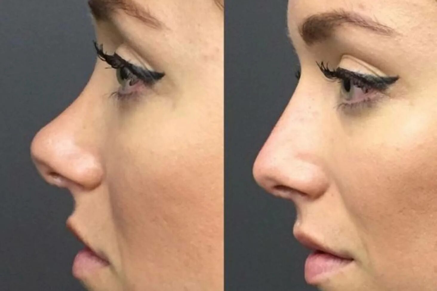 Хайбула камилович ринопластика. Ринопластика горбинки носа. Ринопластика курносого носа. Лит нос. Безоперационная ринопластика носа.