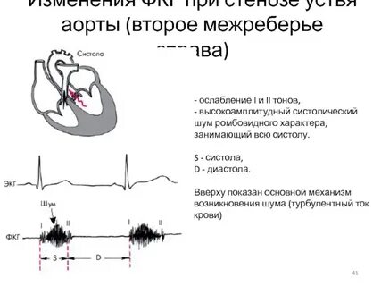 Тон над аортой