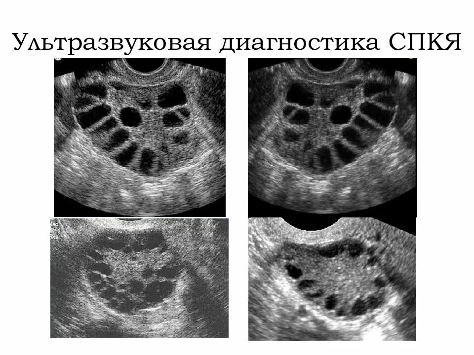 Поликистозные яичники лечение. Мультифолликулярные поликистоз яичников. Синдром поликистоза яичников на УЗИ. Склерокистоз яичников УЗИ.