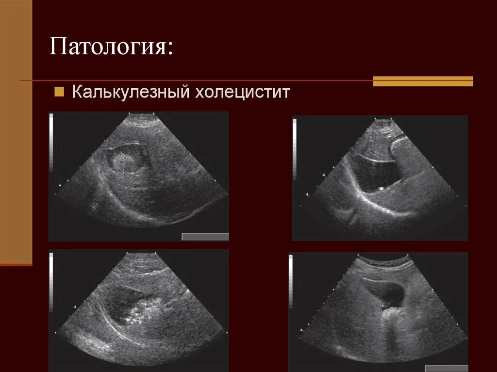 Мкб жкб калькулезный. Кальцинозный холецистит. Калькулезныйхолицистит. Острый калькулезный холецистит. Калькулез желчного пузыря.