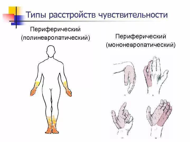 Типы поражения чувствительности. Периферический полиневритический Тип нарушения чувствительности. Мононевропатический Тип расстройства чувствительности. Периферический Тип нарушения чувствительности схема. Таламический Тип расстройства чувствительности.