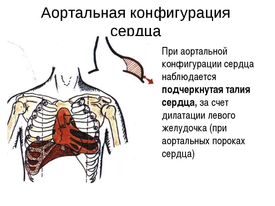 Конфигурации сердца. Конфигурация сердца при аортальных пороках. талия сердца при аортальной конфигурации. митральная и аортальная конфигурация сердца. аортальная недостаточность конфигурация сердца.