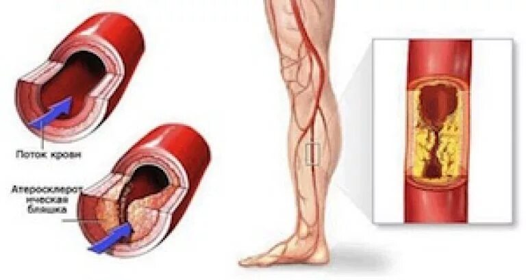 Атеросклеротическое поражение нижних конечностей