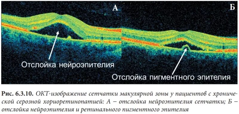 Оптическая когерентная томография отслойка сетчатки. Отслойка нейроэпителия на окт. Окт макулярный отек сетчатки. Окт отслойка пигментного эпителия. Макулярный разрыв после операции