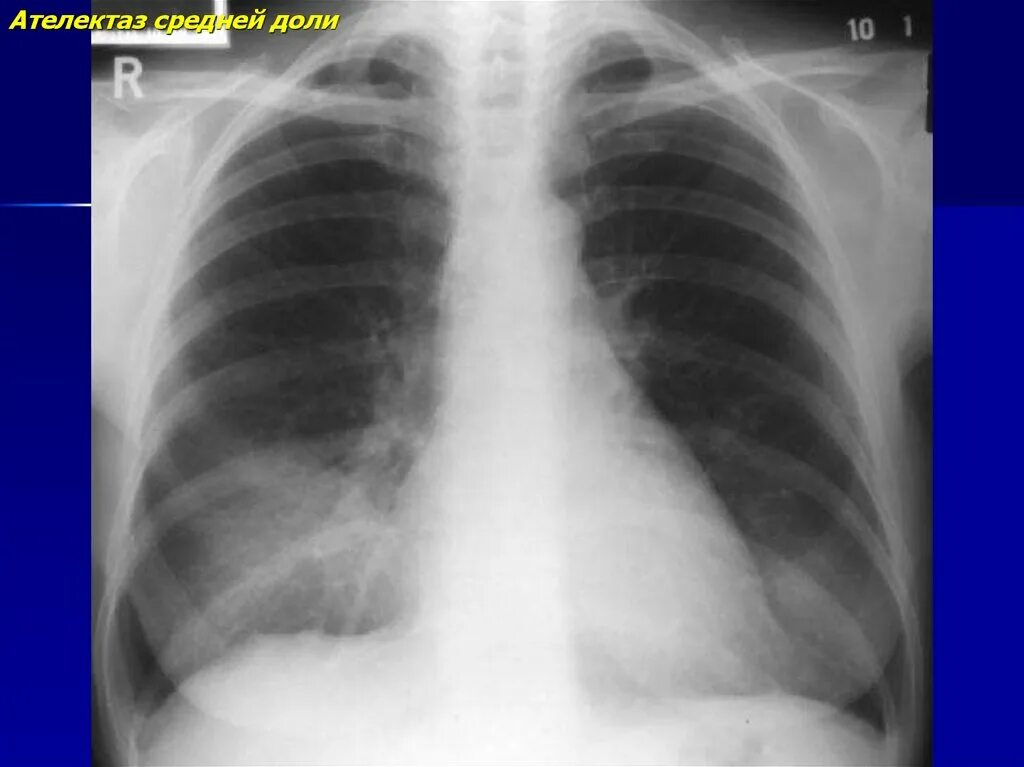 Ателектаз левой доли легкого. Ателектаз верхней доли правого легкого на рентгене. Ателектаз нижней доли правого легкого рентгенограмма. Ателектаз верхней доли левого легкого. Компрессионный ателектаз рентген.