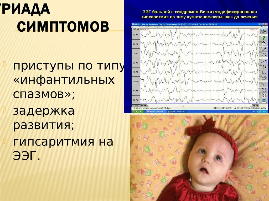 Ээг отзывы детям. Туберозный склероз у детей.