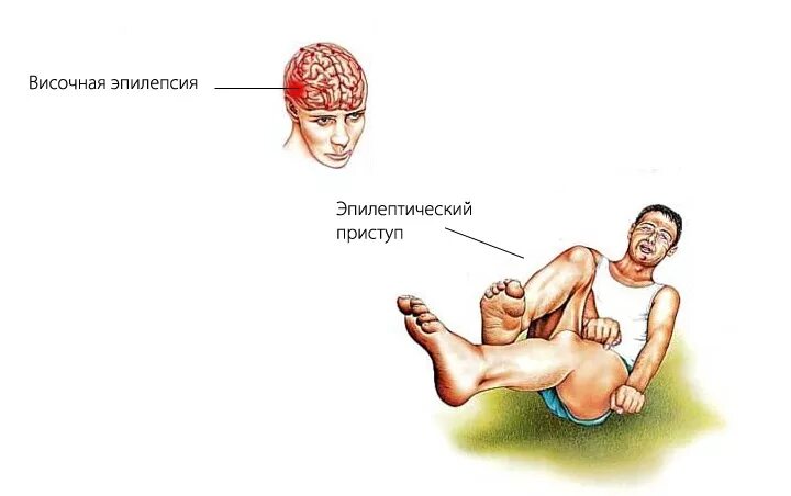 Височная эпилепсия. Эпилептический приступ. Приступы височной эпилепсии. Эпилепсия височных долей.