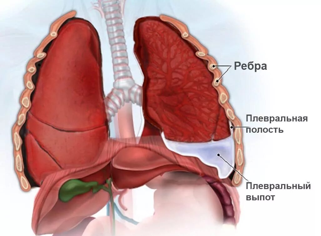 Плевропульмональные спайки. Плеврит и плевральный выпот. Двухсторонний выпотной плеврит. Плевра pleura.
